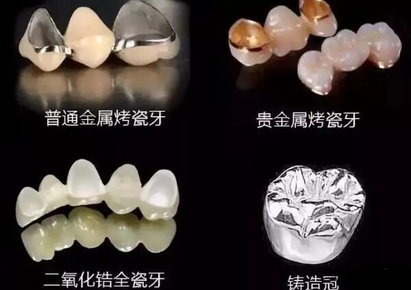 贵金属烤瓷冠(贵金属烤瓷冠和磁共振)