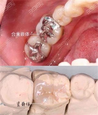 贵金属嵌体(贵金属嵌体多少钱一个)