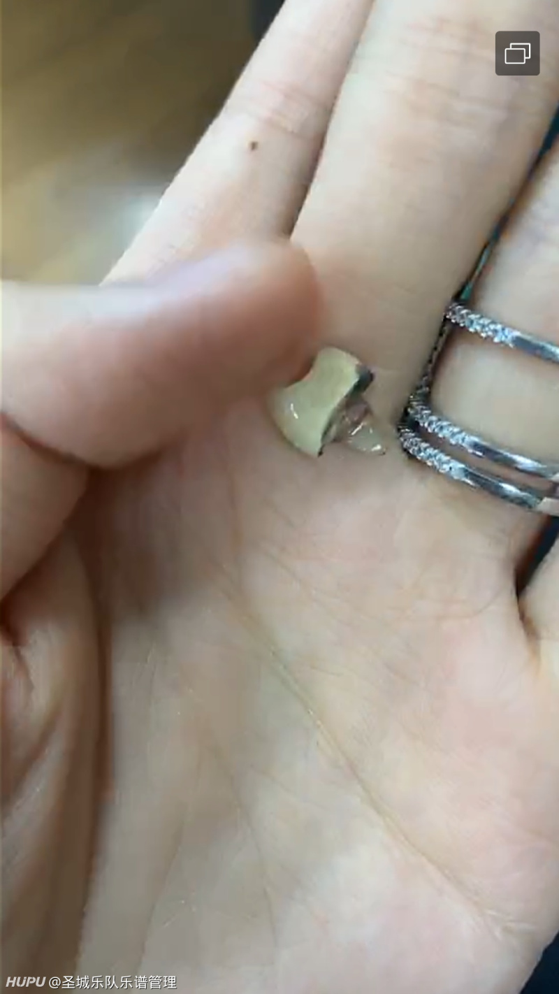 贵金属牙桩(贵金属牙桩能不能拆)