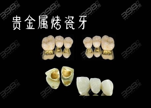 贵金属牙桩(贵金属牙桩做ct有影响嘛)