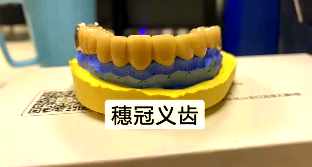 贵金属烤瓷冠(烤瓷牙多少钱一颗价格表2025)