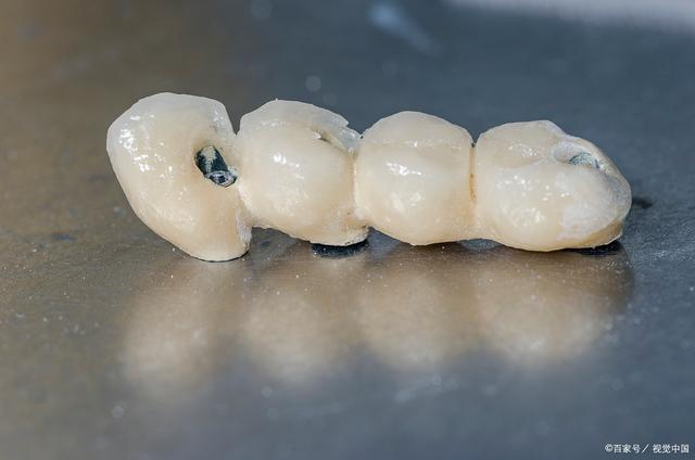 贵金属烤瓷冠(贵金属烤瓷冠适合什么人)