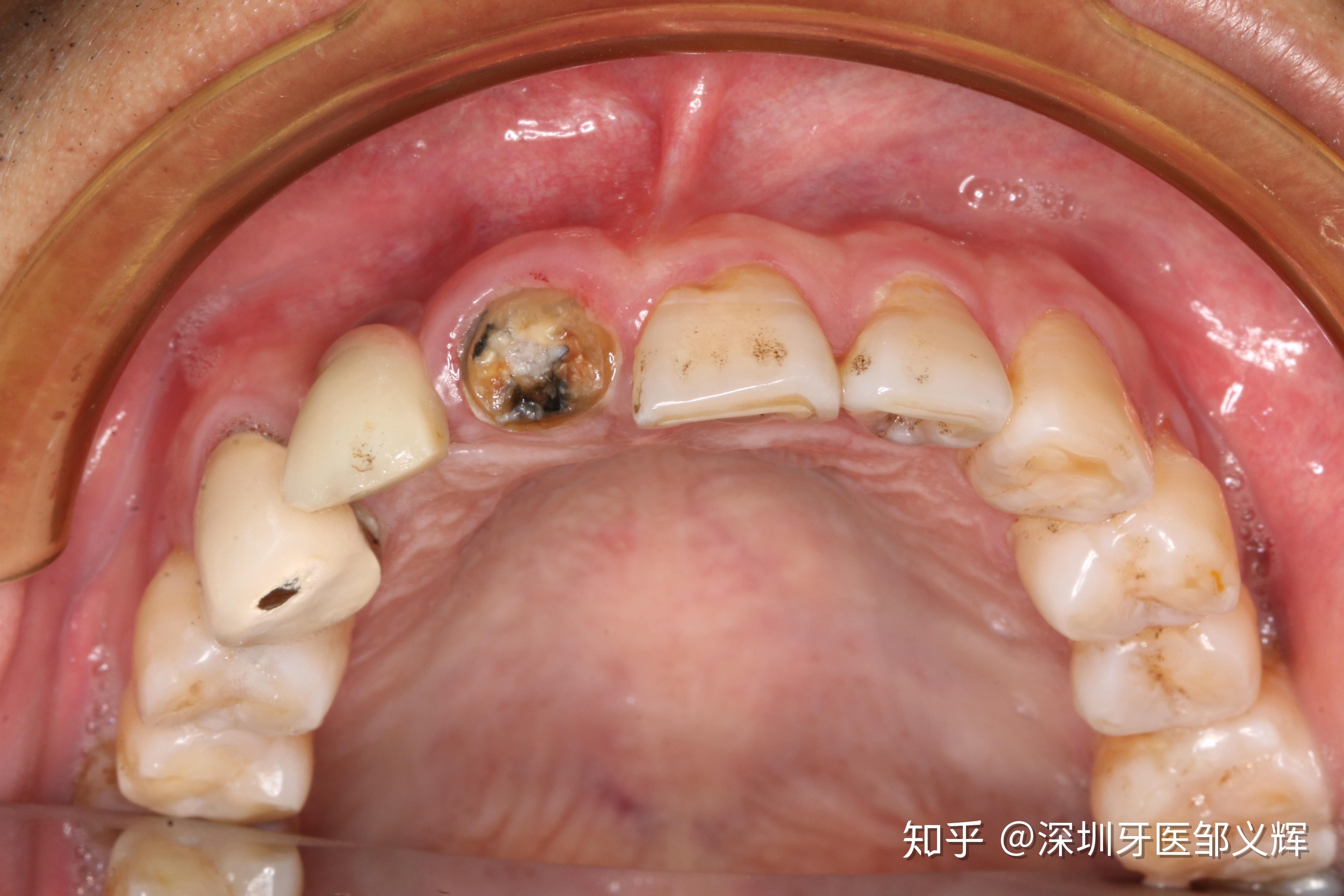贵金属牙桩(贵金属牙桩最怕三个东西)