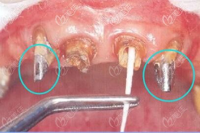 贵金属牙桩(贵金属牙桩最忌三种人)