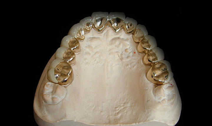 贵金属牙桩(贵金属牙桩会不会断裂)