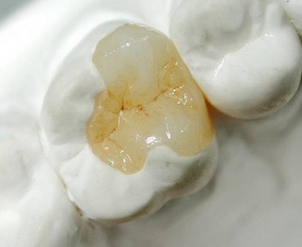 贵金属嵌体(金属嵌体价格) 贵金属嵌体(金属嵌体价格)