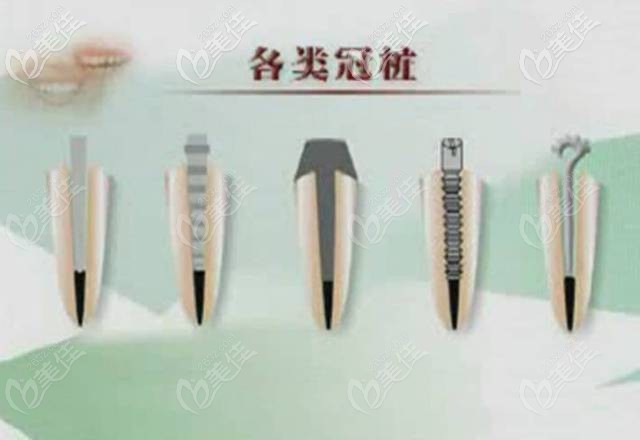 贵金属牙桩(金属牙桩一般有什么材料) 贵金属牙桩(金属牙桩一般有什么材料)