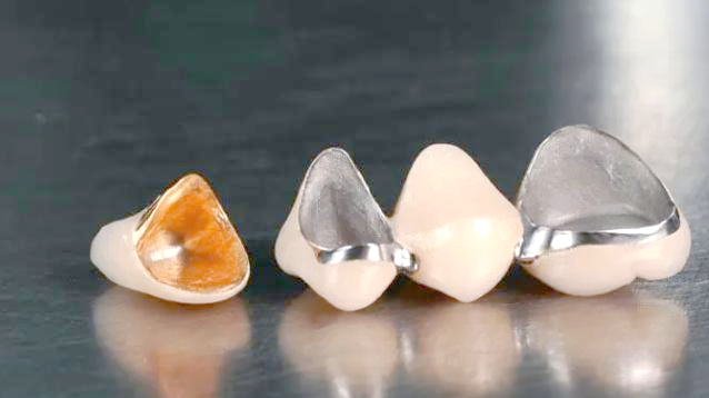 贵金属牙桩(贵金属牙桩的分类) 贵金属牙桩(贵金属牙桩的分类)